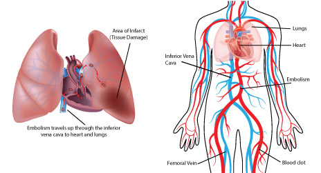 DVT-diagrams